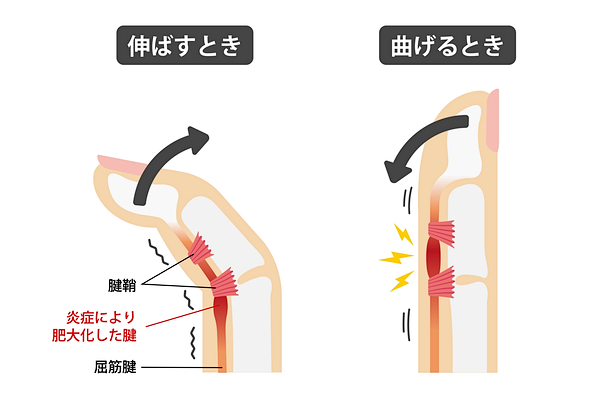 腱鞘炎の様子