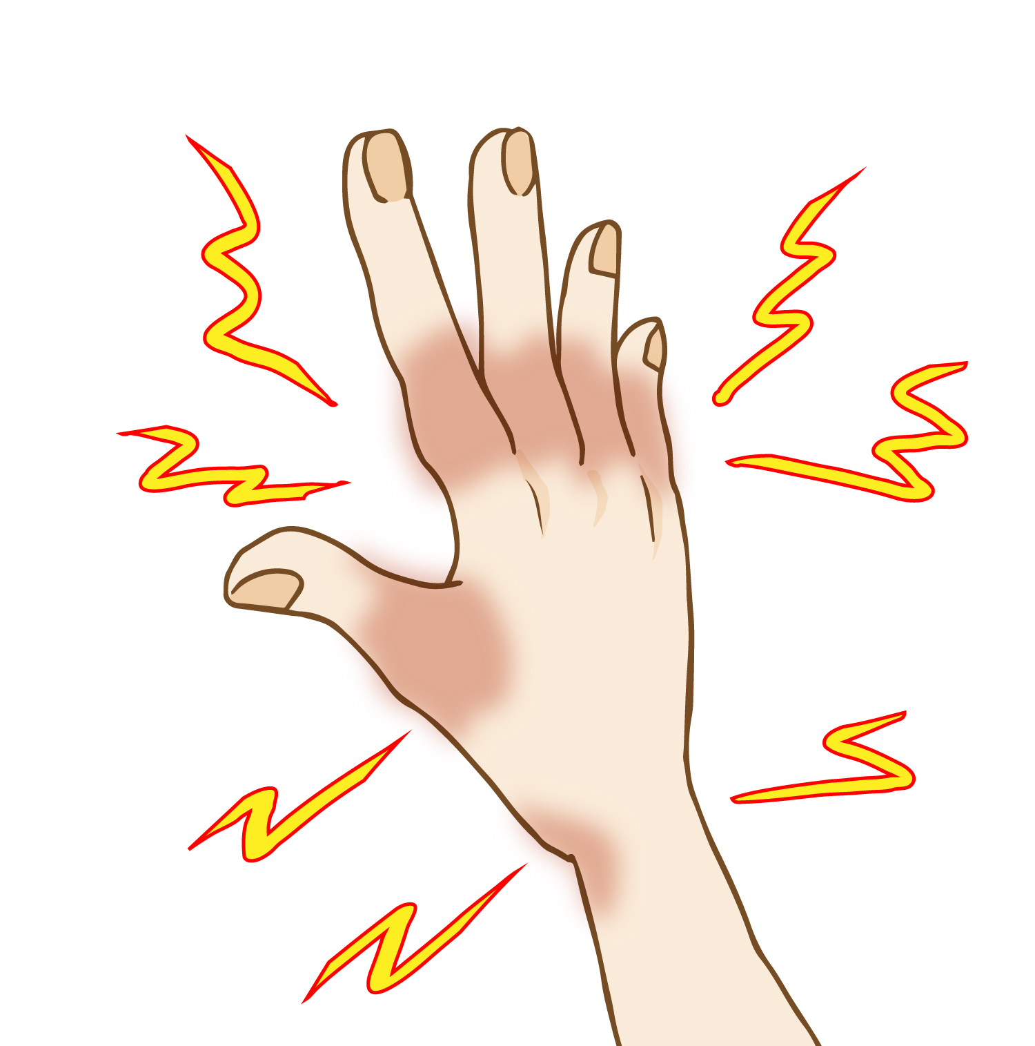 腱鞘炎・ばね指の改善を目指すなら｜早期ケアで悪化・再発を防ぐ 画像